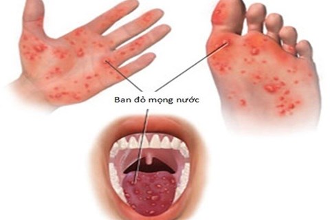 Vi rút Enterovirus 71 đã trở lại gây ra bệnh tay chân miệng ở trẻ em